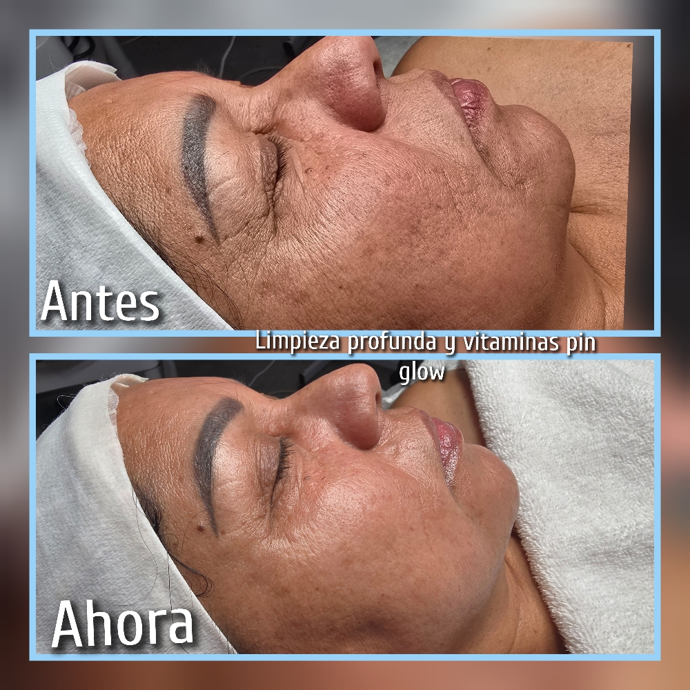 Facial Con Vitaminas Y LIMPIEZA