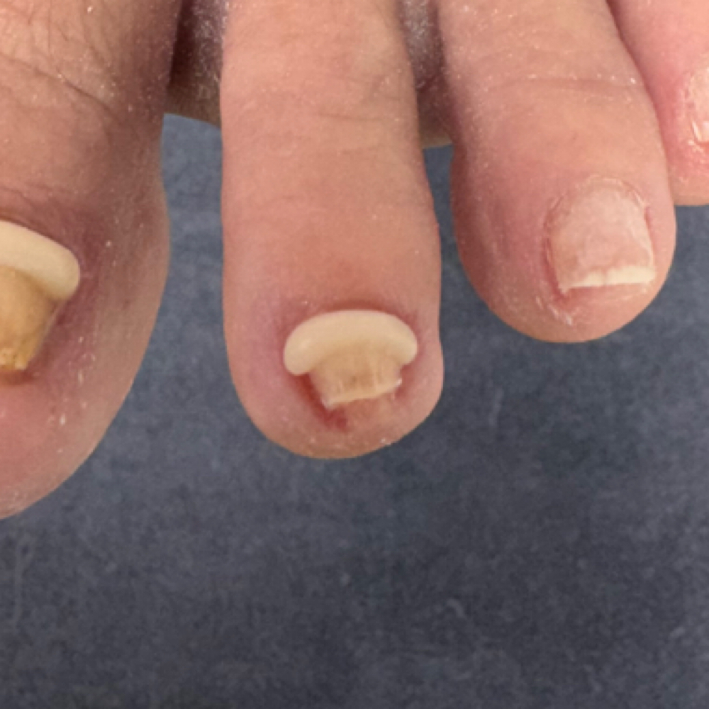 Toenail Brace - SMALL at Southern Oregon PEDICURE CLINIC in Medford, OR