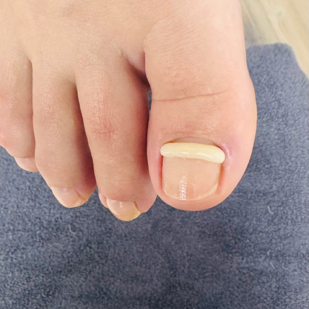 Nail Brace- Added Onto A Pedicure at Southern Oregon PEDICURE CLINIC in Medford, OR