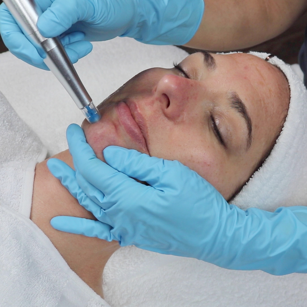 Rezenerate Nano Needle Facial