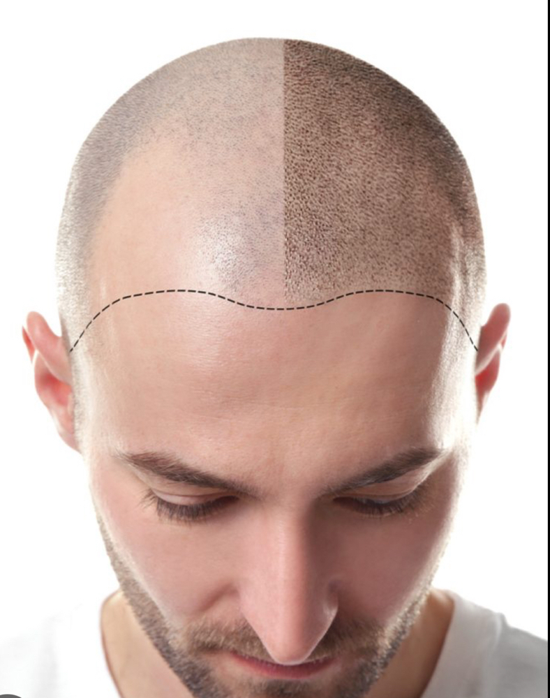 Scalp Micropigmentation