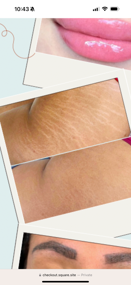 Scar/ Strech Mark Removal