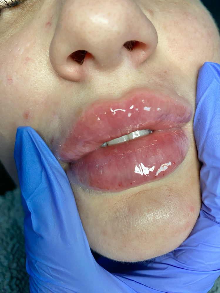 2.2 MICRONeedle Lip Fillers