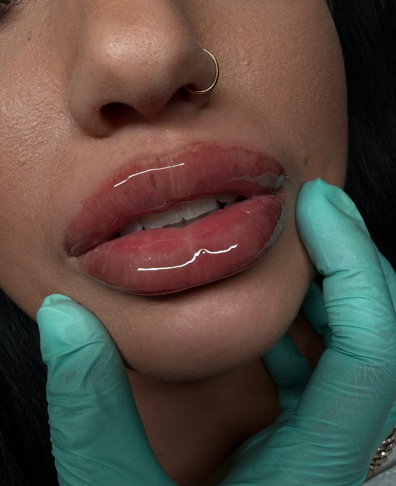 2.2 MICRONeedle Lip Fillers at Lash’D & Lipp’D X Unique in Fort Worth, TX