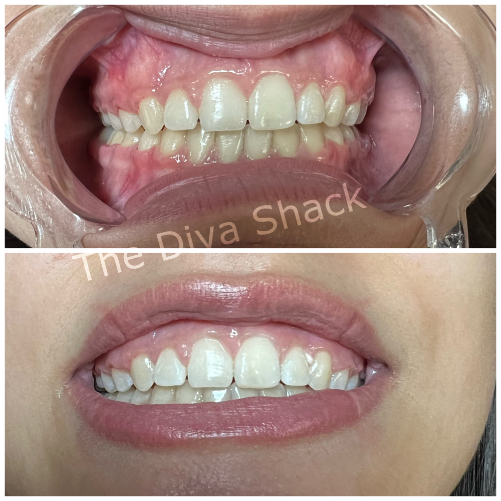 Teeth Whitening