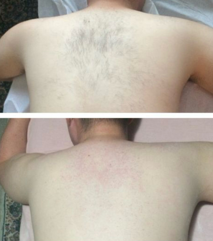 Upper Back Wax