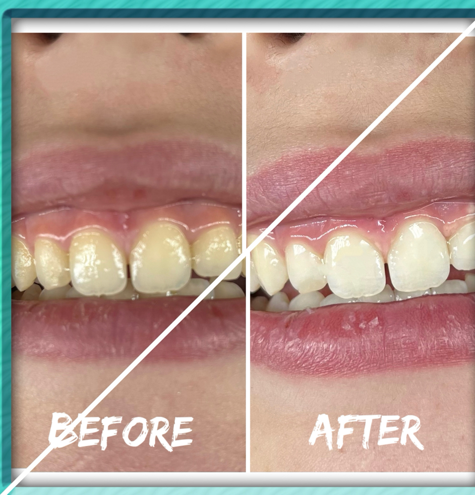 Teeth Whitening