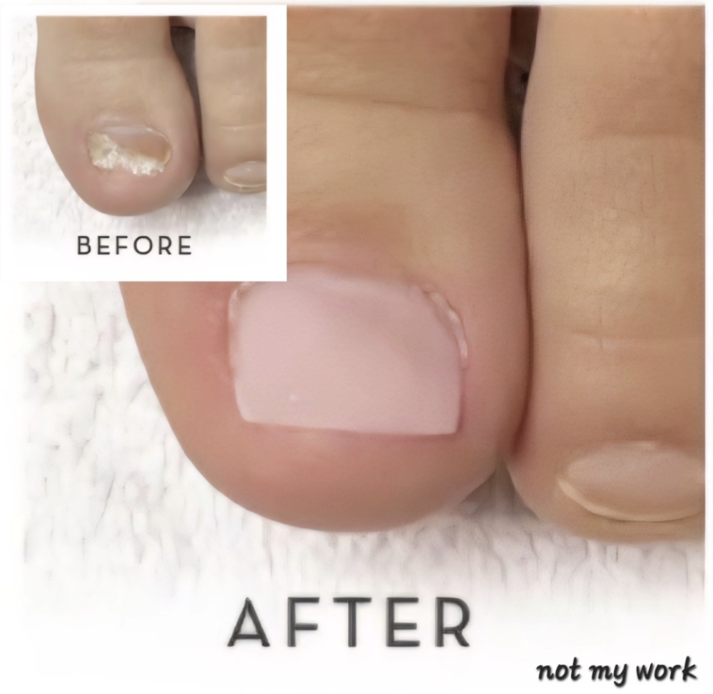 Toenail Reconstruction