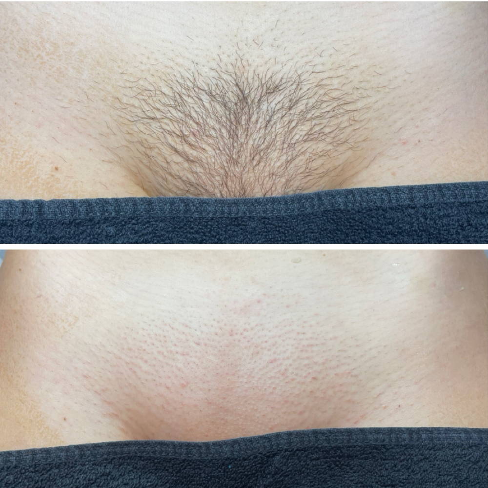 Brazilian Wax - Returning Client at Beauty By Randi in Farmington, MI