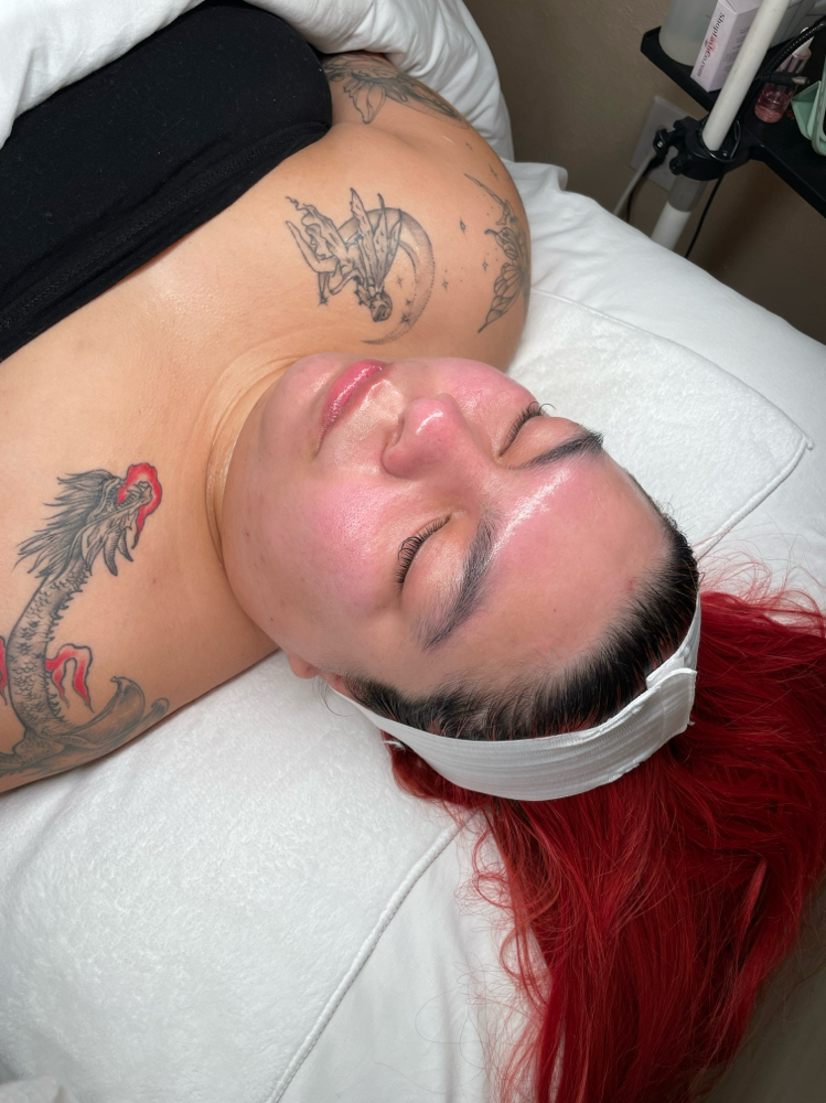Chemical Peel