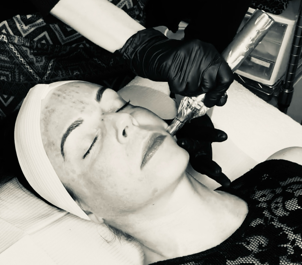Microneedling at The Aesthetic Skincare in Mesa, AZ