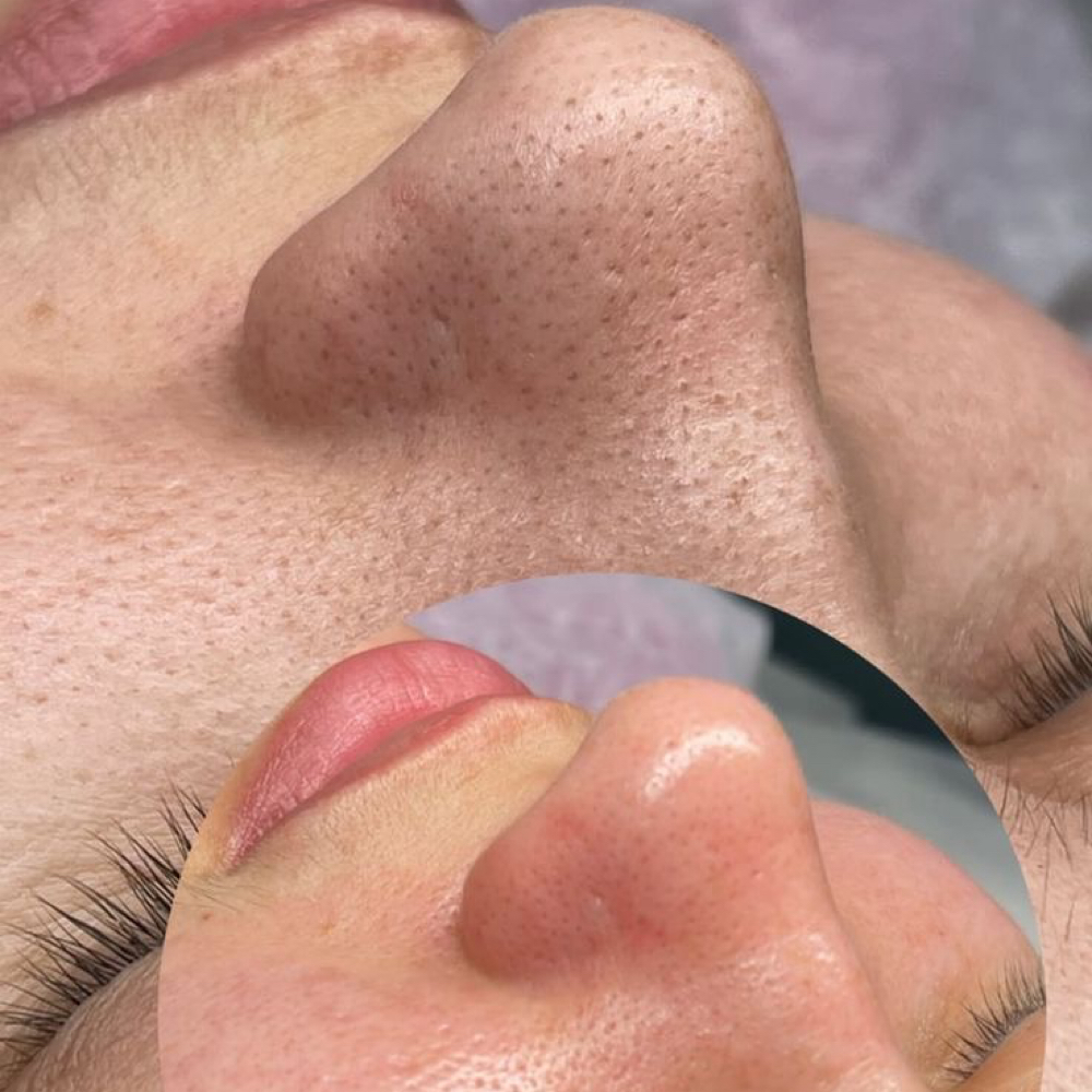 Acne Renewal Facial at Enava Beauty in Sioux Falls, SD