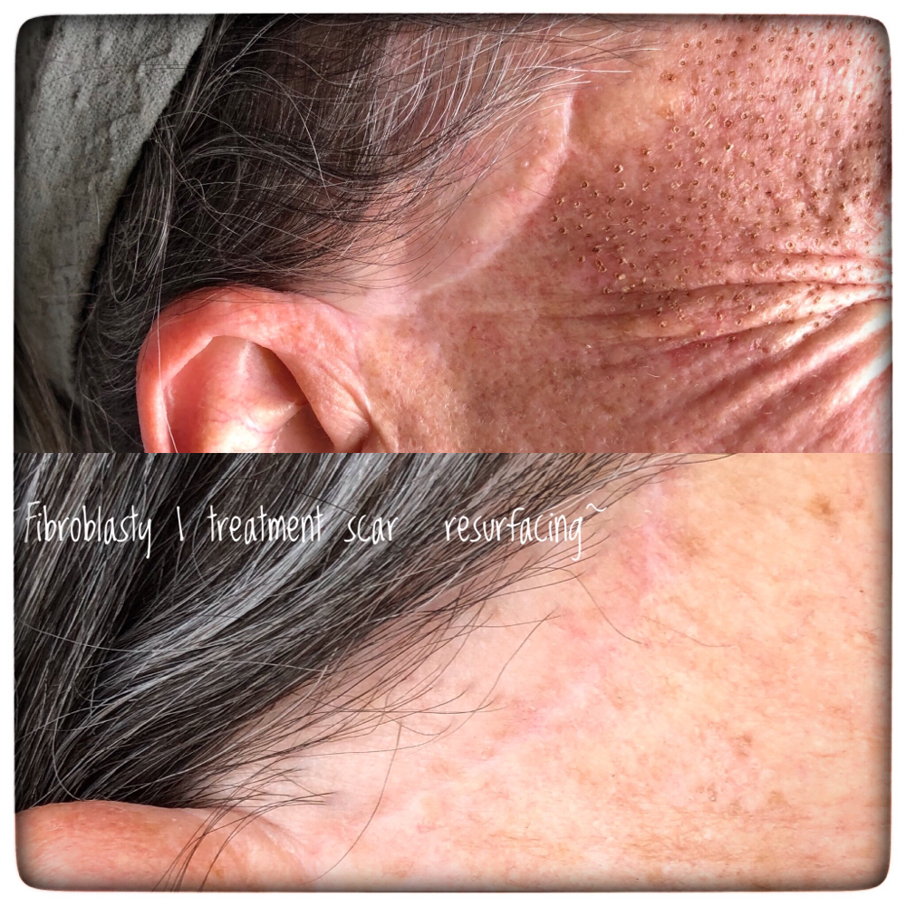 Fibroblasty-Scar Resurfacing