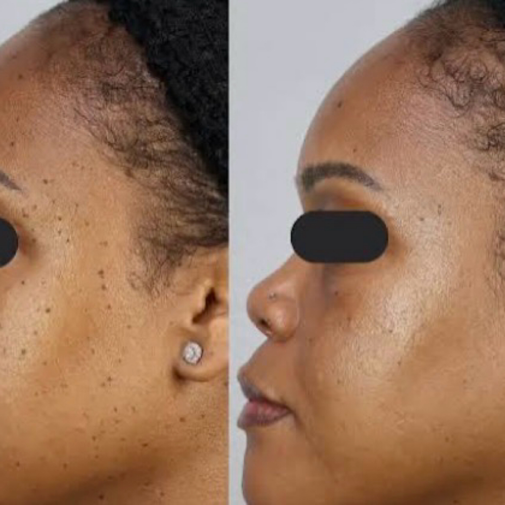 Mole Removal at BLAZEBODYSPA & BEAUTY BAR in TINLEY PARK, IL