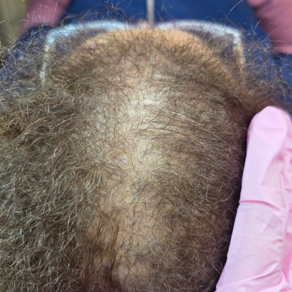 Personalized Hair Restoration Treat at SiempreBellasBeautySpa in North Miami, FL