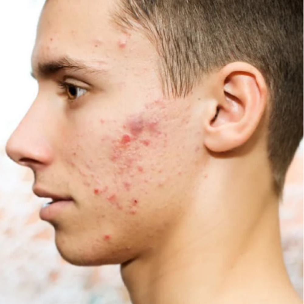 Acne Correction & Barrier Healing at Tanning Mode in Las Vegas, NV