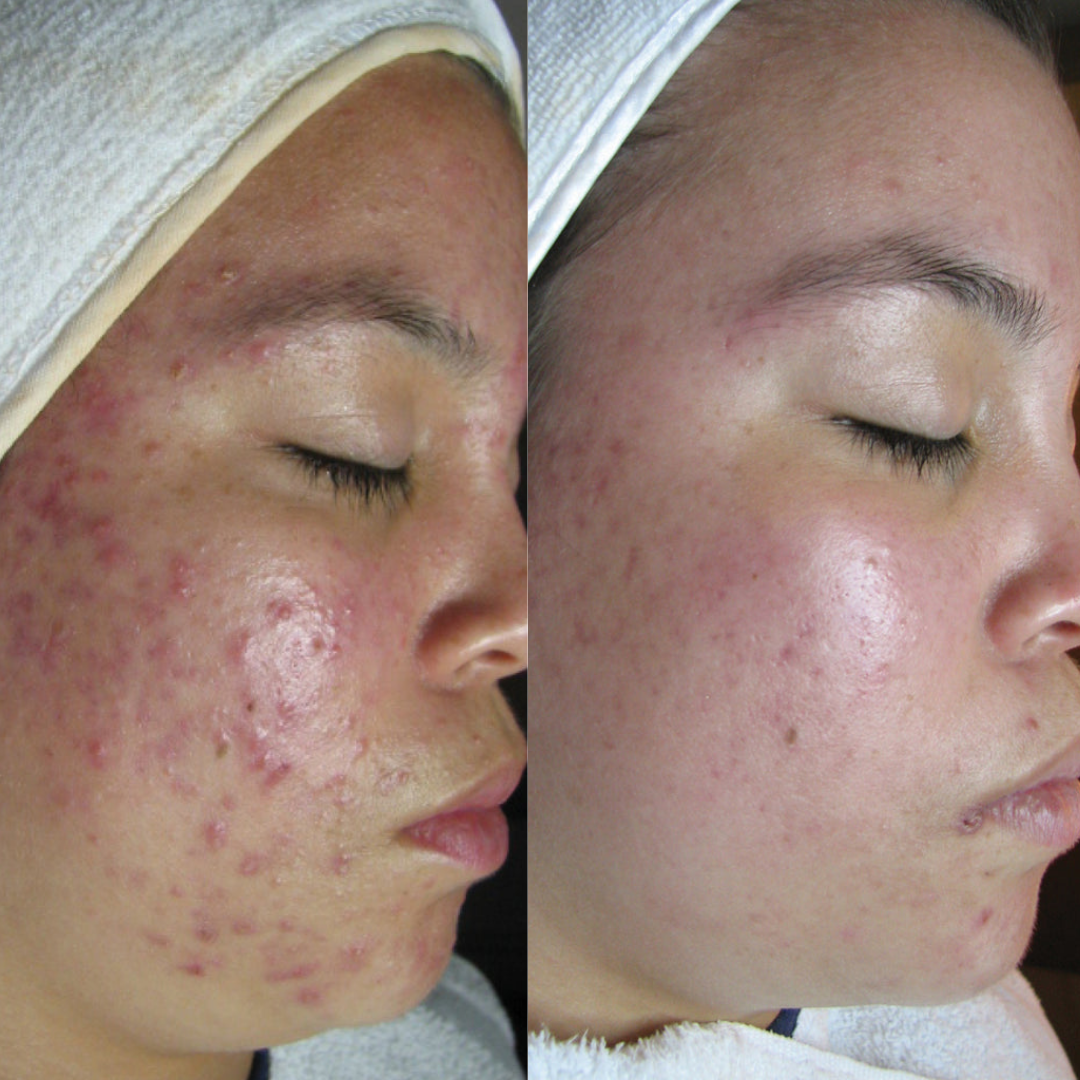 Virtual Acne Bootcamp Consultation