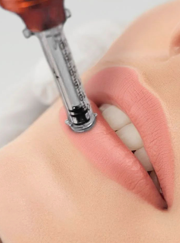 Volume Lips w/ Hialuron Pen