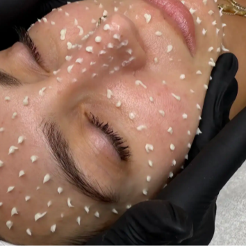 Korean Liquid Microneeding at Ethical Esthetics in Bedford, NH