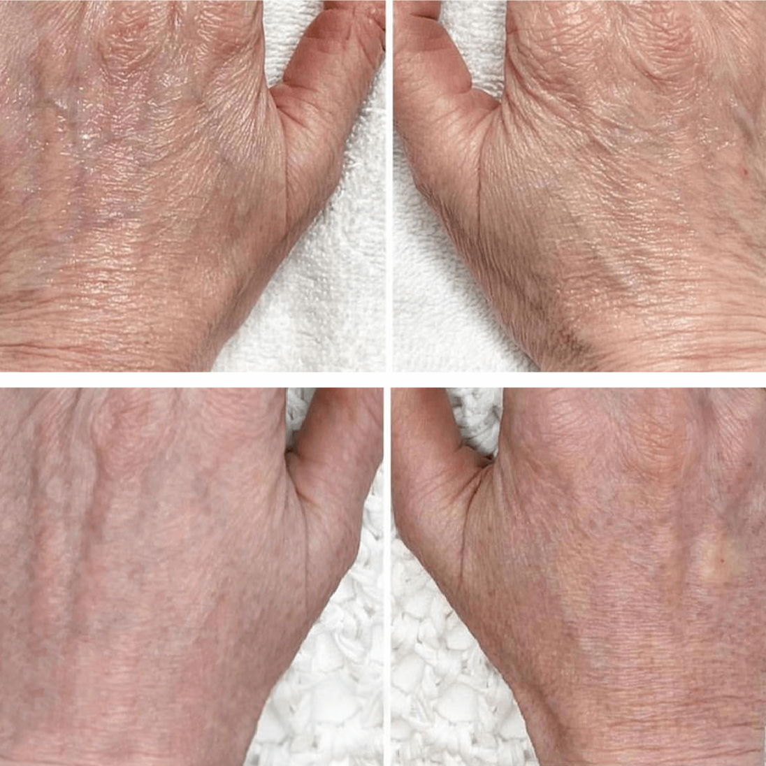Fibroblast Treatment (Hands) at Luscious Tox Aesthetics in Arlington, TX