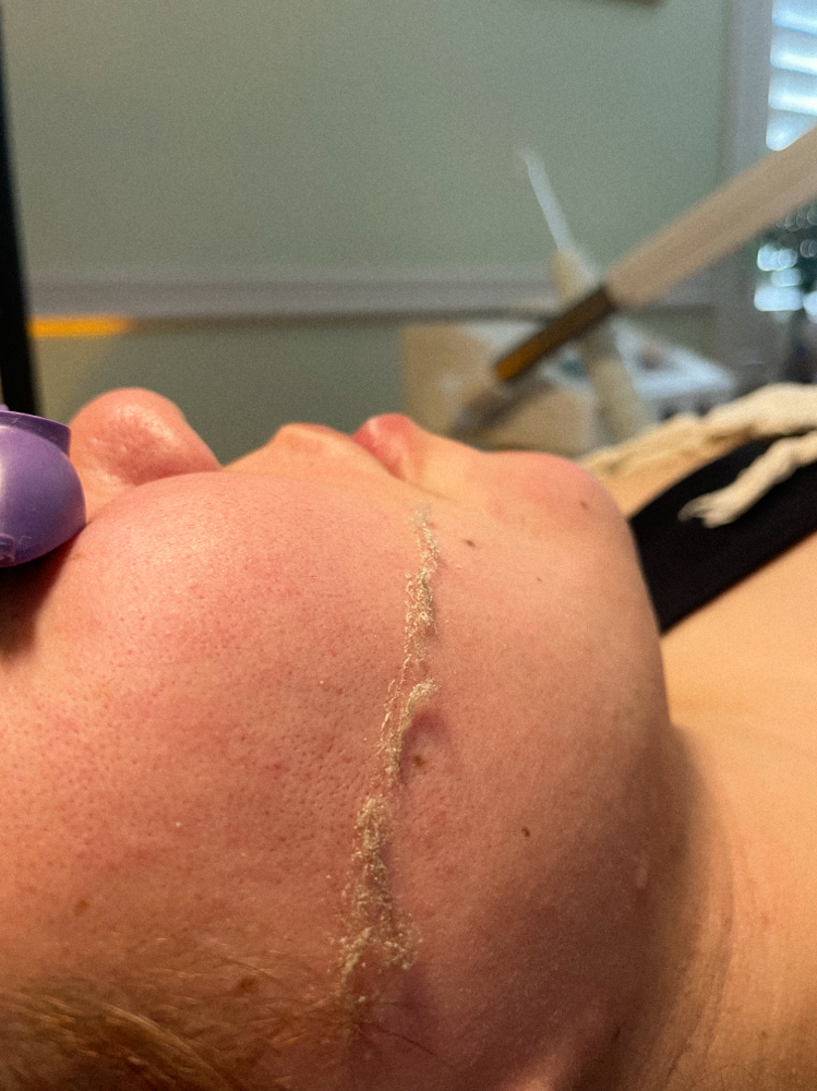 Dermaplane add on