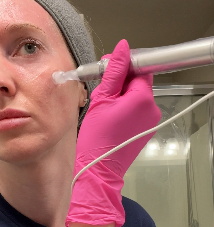 Microneedling