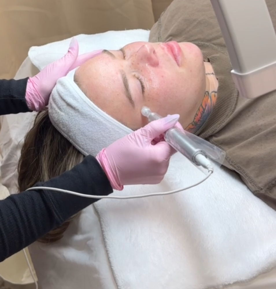 Microneedling