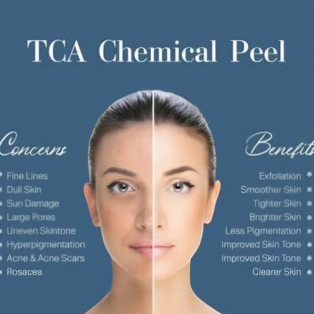 TCA Peel (10%) at Beauty & Balance in Collinsville, OK