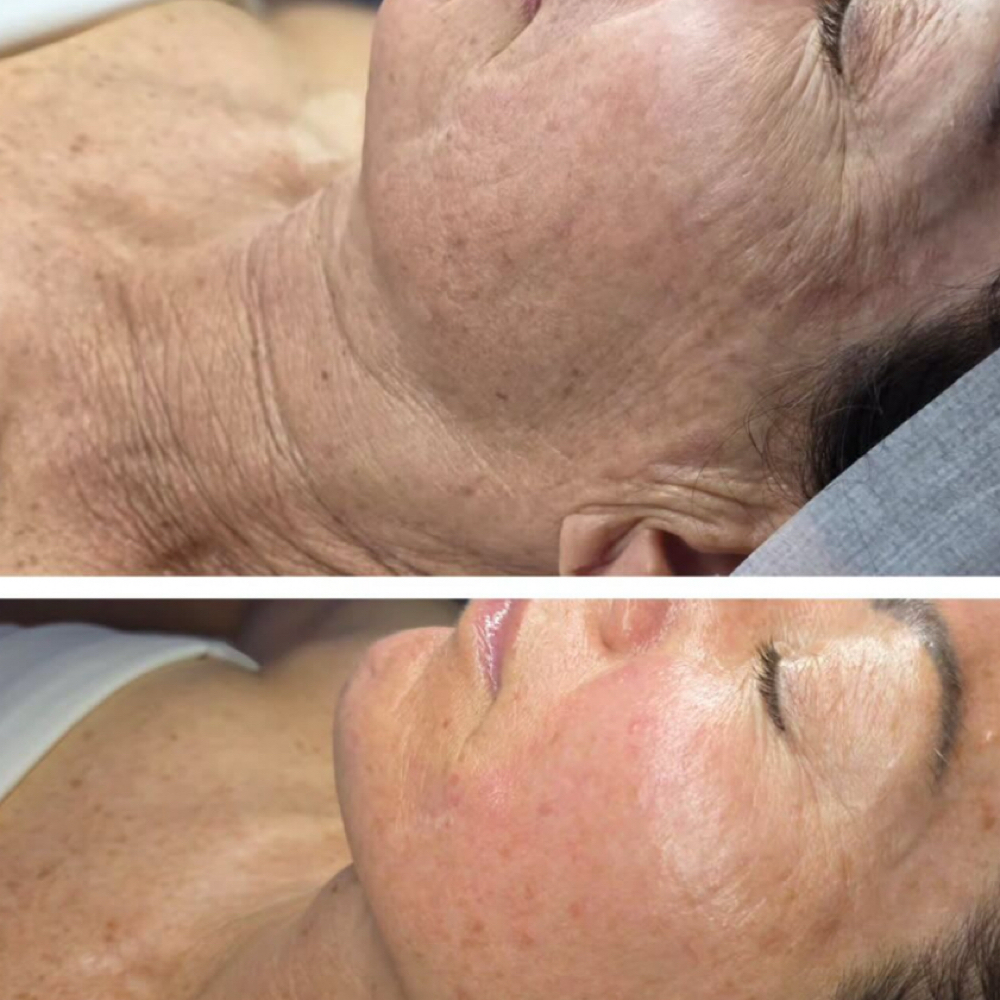 Firming Anti aging facial at Empire Beauty Bar in Wappingers Falls, NY
