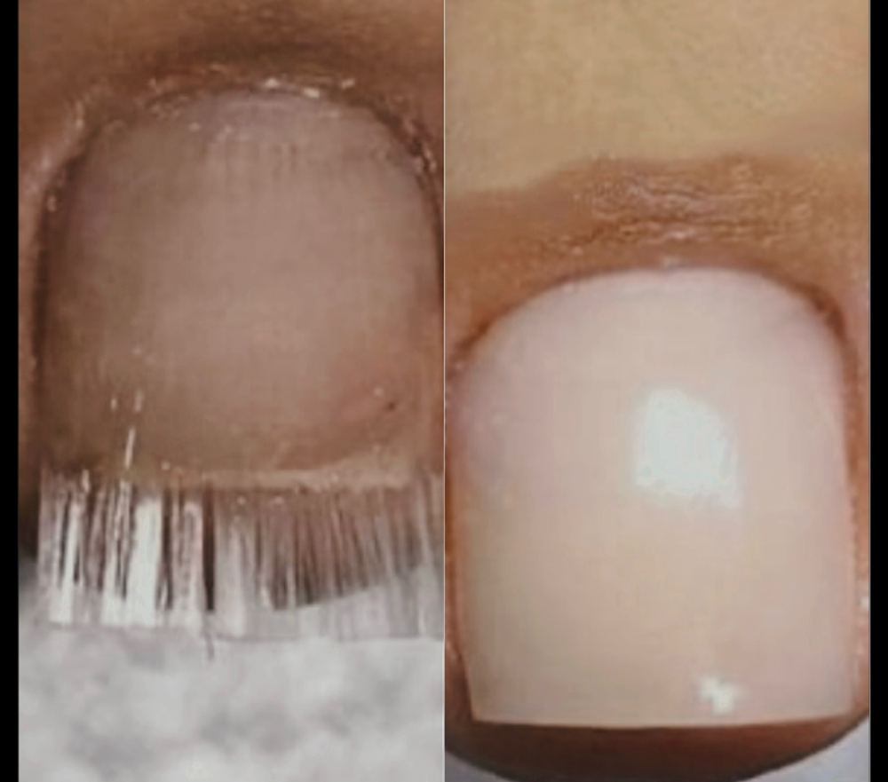 Fiberglass Toe Set