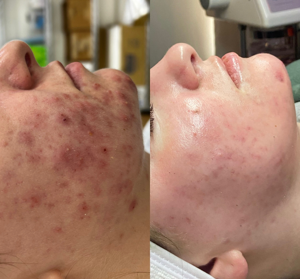 Face Reality Acne Peel