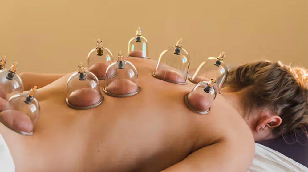 Cupping