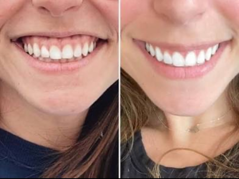 Gummy Smile at Pamper Me Pretty Beauty in Anderson, TX