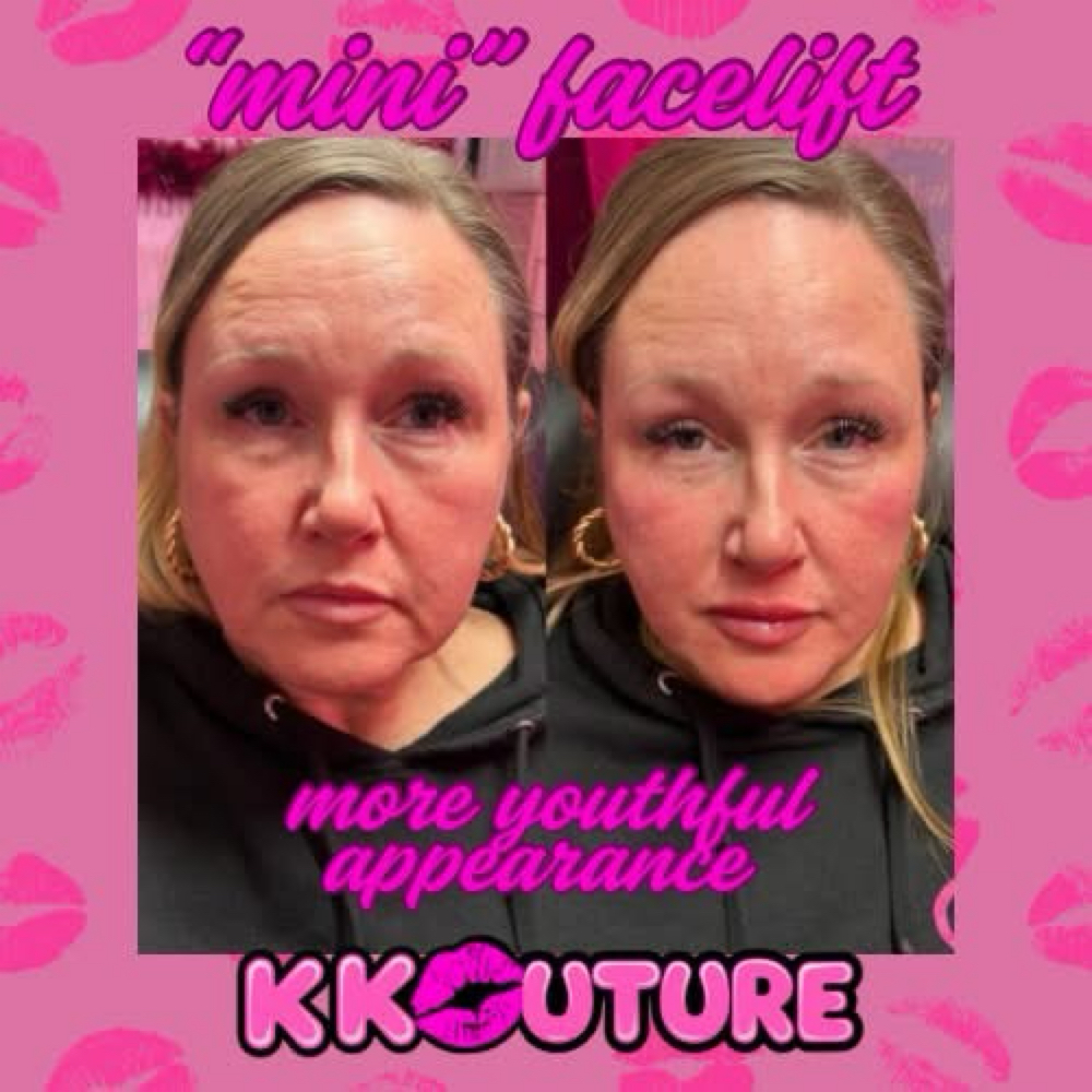 Complete Face Facial Balancing at k kouture in Fort Worth, TX