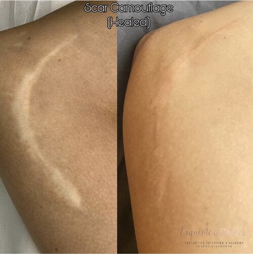 Scar Camouflage