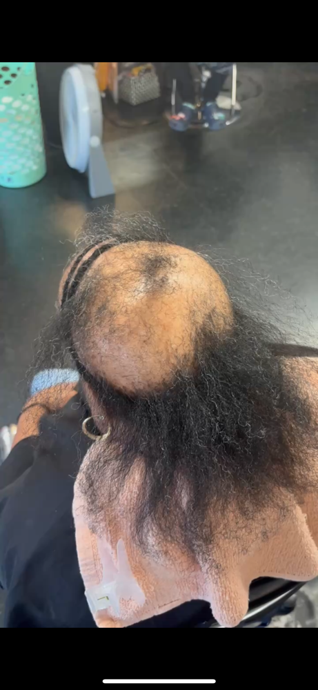 Sew-in for Alopecia