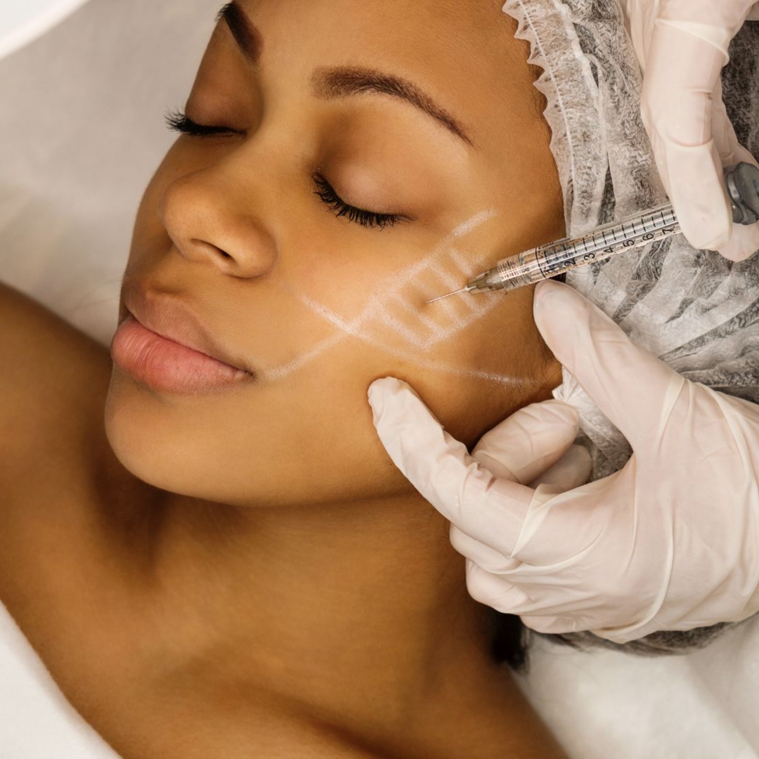 Cheek Filler at RevIVeU - Bridgeport in Bridgeport, WV