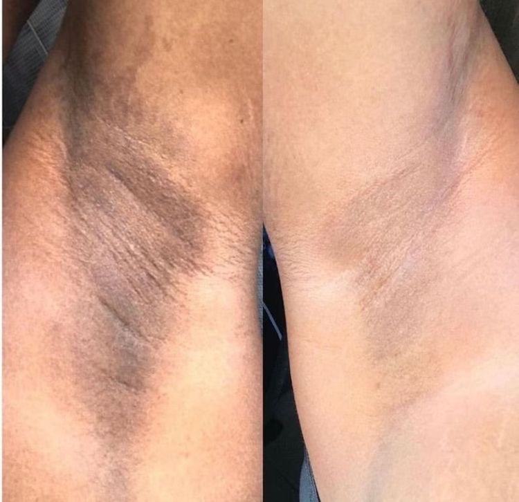 UNDER ARM BRIGHTENING