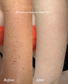 IPL/Photo Rejuvenation / Arms