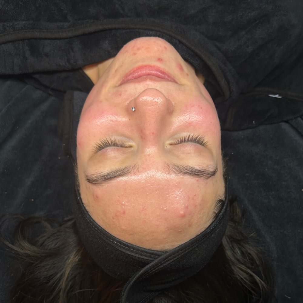 Follow Up Acne Treatment at Not the Body Shop in Littleton, CO