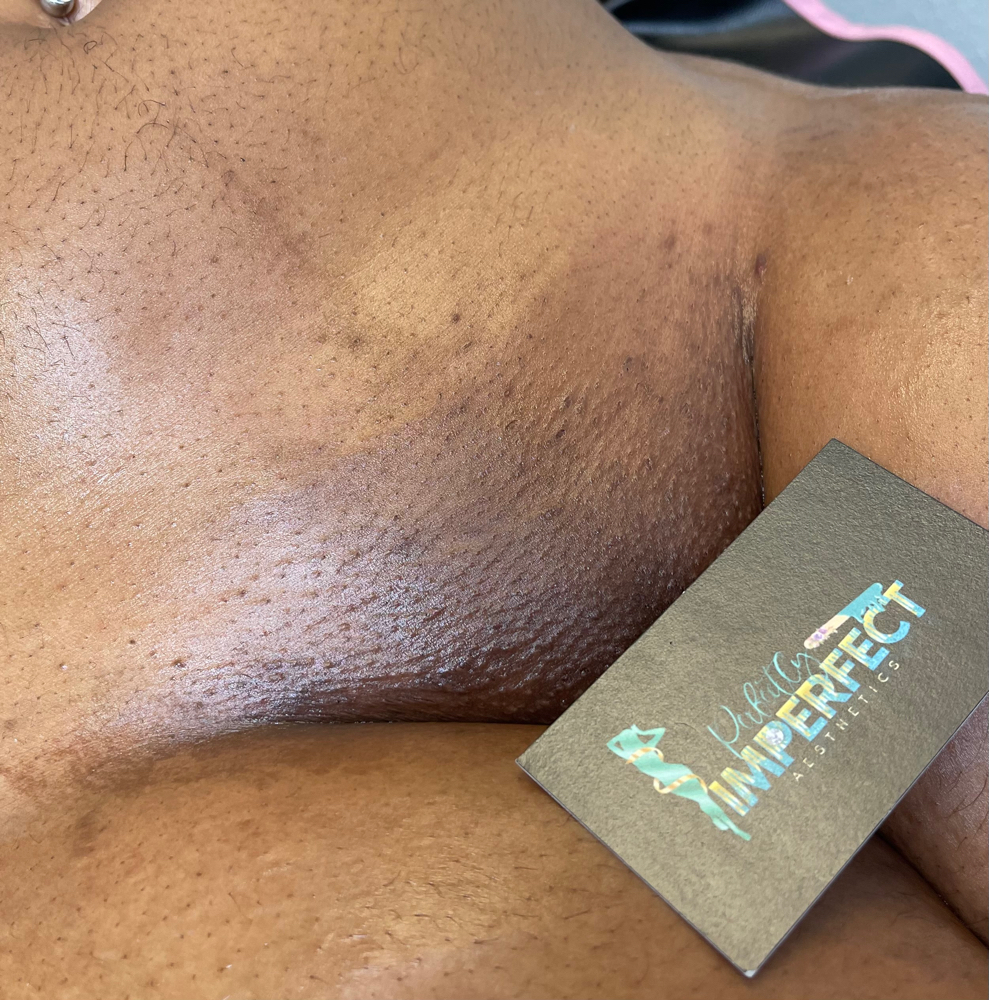 Brazilian + Intimate Peel