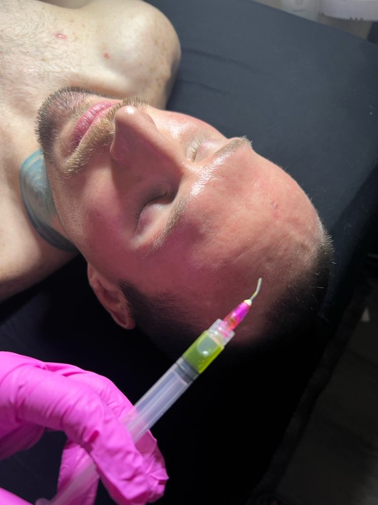 BioRePeel Basic Facial (NECK + FACE)