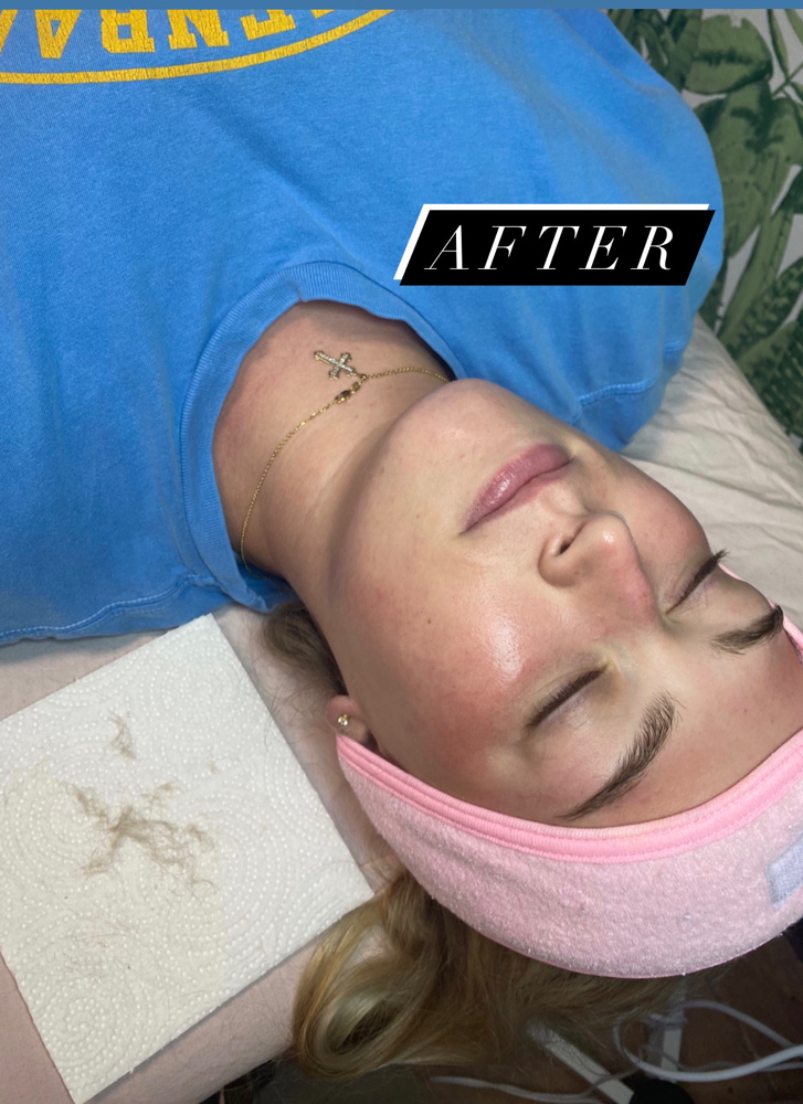 Dermaplaning Facial