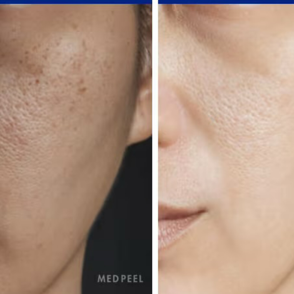 Salicylic Acid Acne Peel at Cedar & Sage Aesthetics & Wellness in Hiawassee, GA
