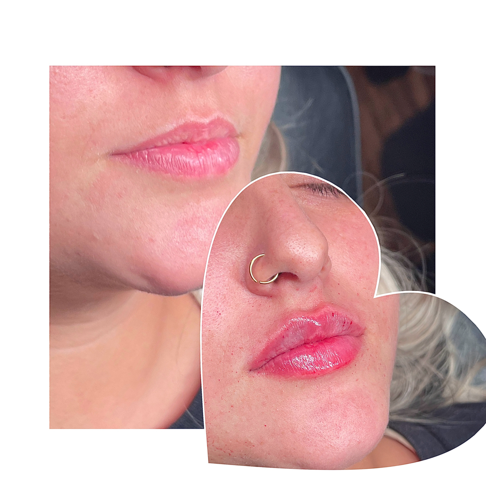 Russian Lip Technique + GFE