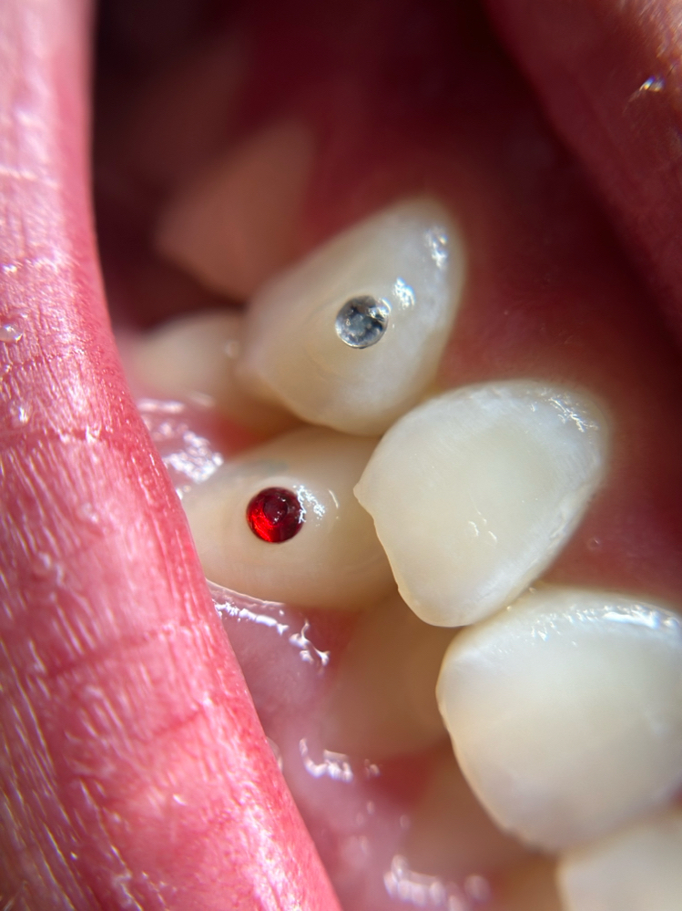 Tooth Gem