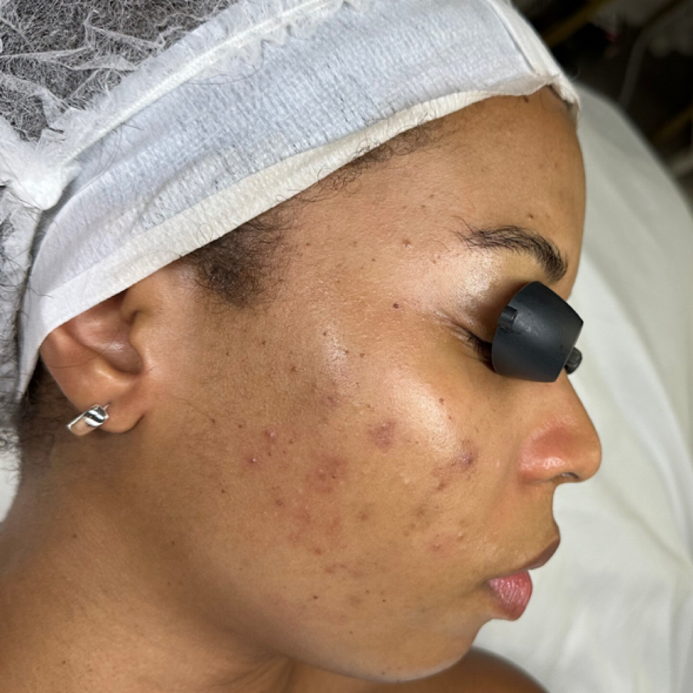 Pigment Program at Poised Esthetics & Co. in Marietta, GA