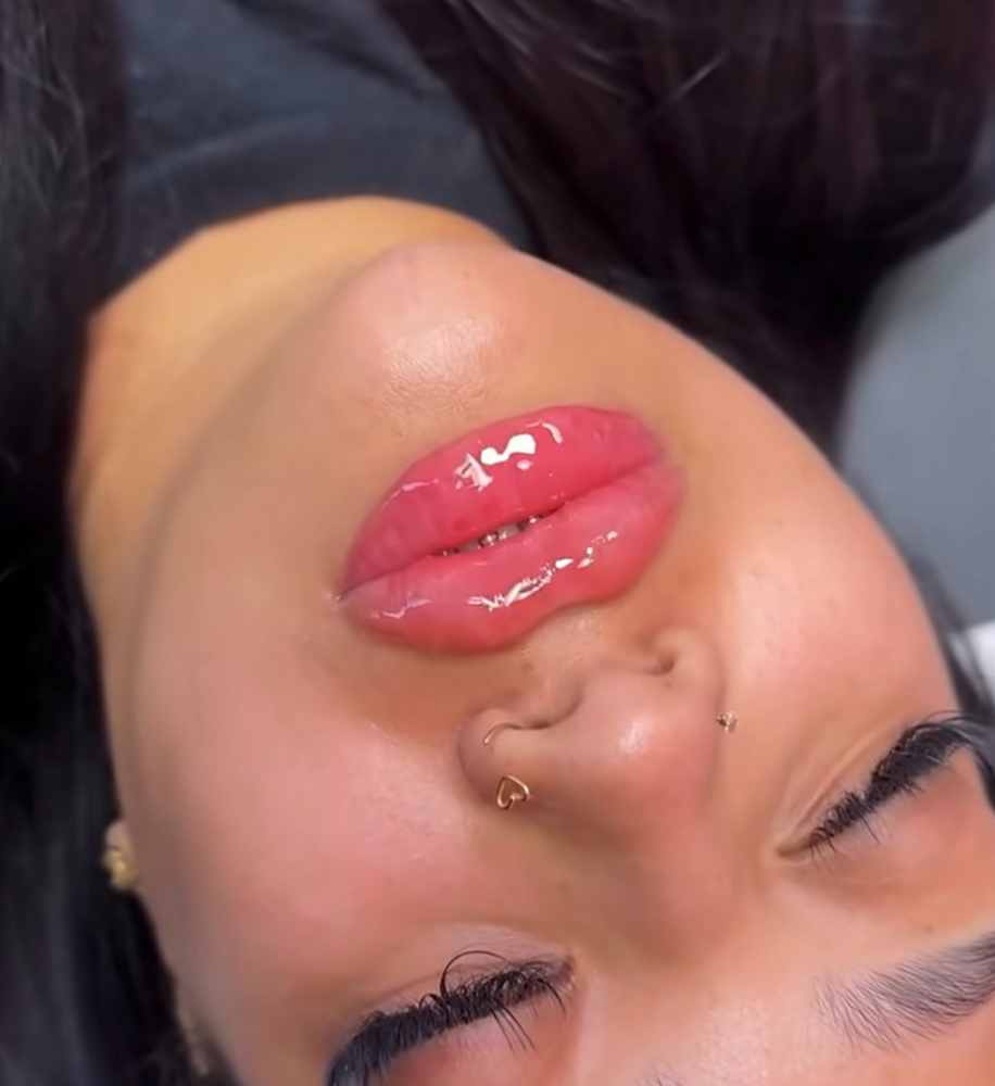 🫧Lip + Chin Filler Special🫧