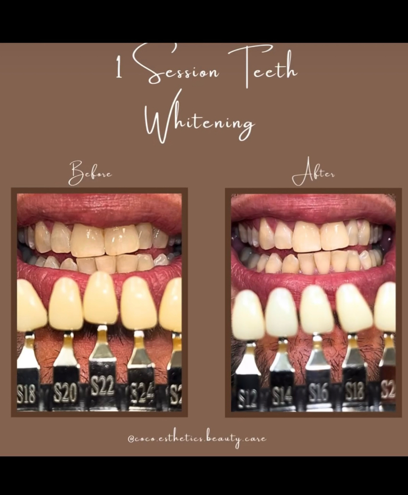 Teeth Whitening