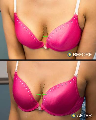 Breast Rejuvination